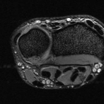 Extensor carpi ulnaris tendinopathy | Radiology Reference Article ...