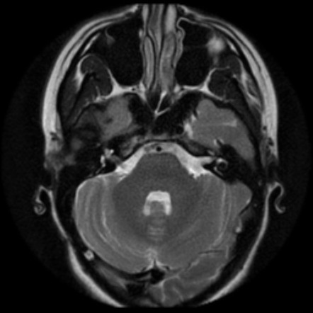 White epidermoid | Image | Radiopaedia.org