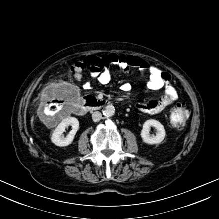 Colo-enteric fistula | Radiology Reference Article | Radiopaedia.org