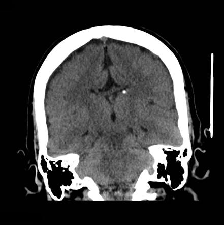 Chiari II malformation | Image | Radiopaedia.org