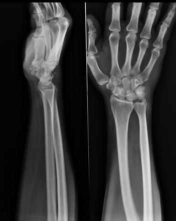 Wrist radiograph (an approach) | Radiology Reference Article ...