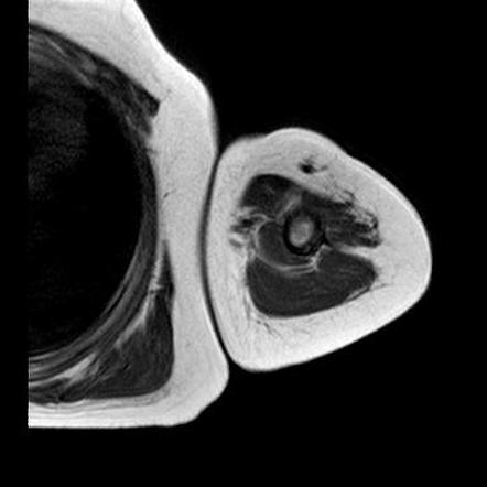 Aneurysmal bone cyst complicated by pathological fracture | Image ...