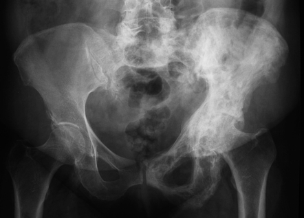 Paget disease of bone | Radiology Case | Radiopaedia.org