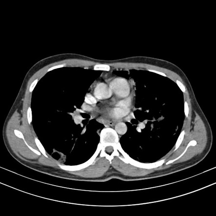 Chronic eosinophilic pneumonia | Image | Radiopaedia.org