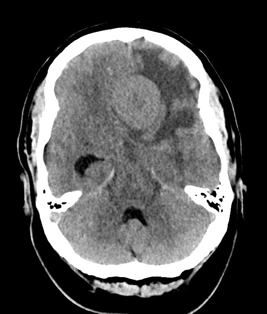 Meningothelial meningioma with abundant oedema | Radiology Case 