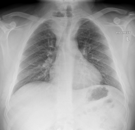 Superior mediastinal abscess | Radiology Case | Radiopaedia.org