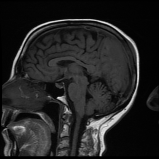 Atypical meningioma with calvarial involvement | Image | Radiopaedia.org