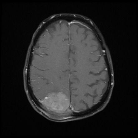 Atypical meningioma with calvarial involvement | Radiology Case ...