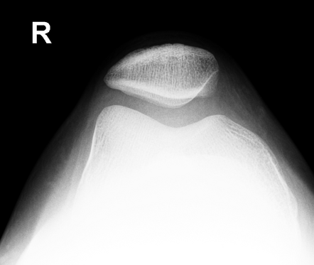 Dislocated proximal tibiofibular joint | Image | Radiopaedia.org