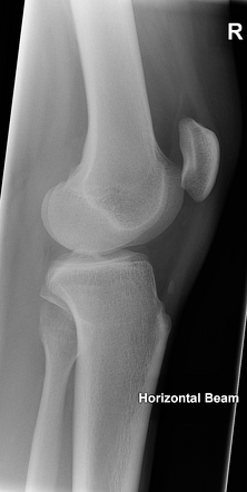 Dislocated proximal tibiofibular joint | Image | Radiopaedia.org