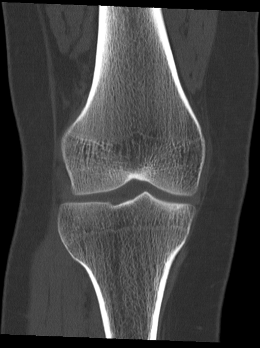 Dislocated proximal tibiofibular joint | Image | Radiopaedia.org