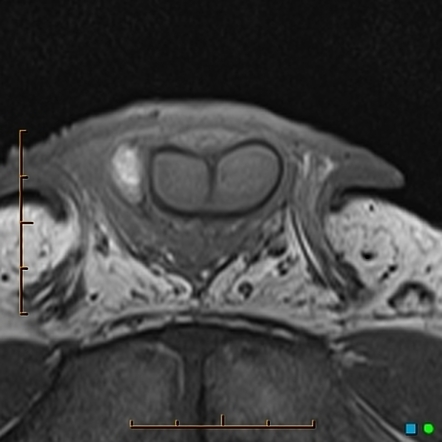 Ruptured Corpus Cavernosum - Penile Fracture | Image | Radiopaedia.org