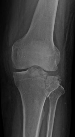 Lipohemarthrosis | Radiology Case | Radiopaedia.org