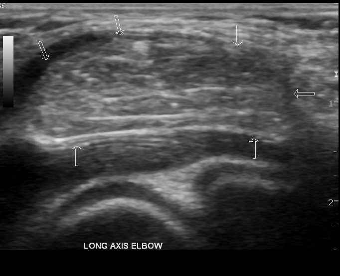 Elbow lipoma | Image | Radiopaedia.org