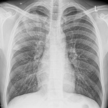 Playlist 'Chest xray' by neilgperera