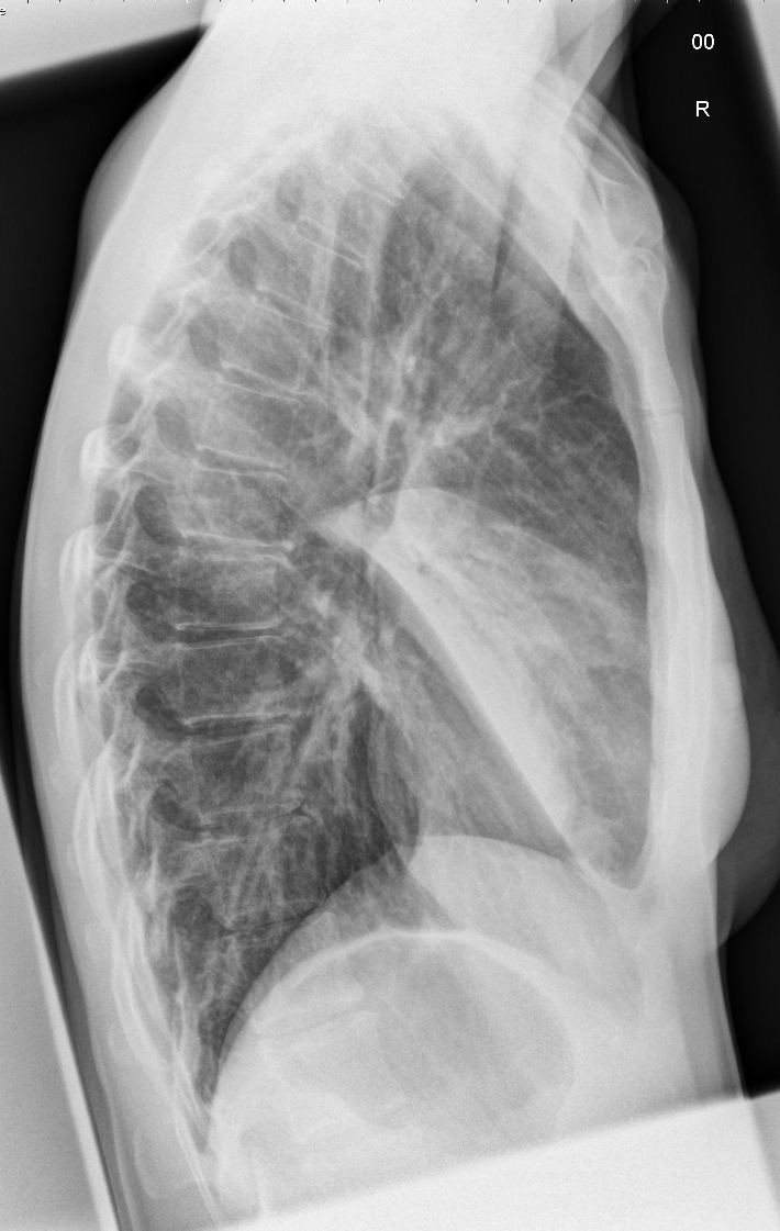 Плевропневмония. Lobar pneumonia x ray. Плевропневмония рентген. Плевропневмония рентген признаки. Бронхопневмония и плевропневмония.