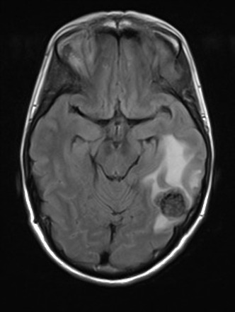 Metastatic colorectal adenocarcinoma - lung and brain metastases ...