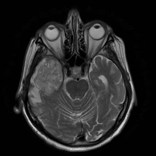 Glioblastoma IDH wild-type | Image | Radiopaedia.org