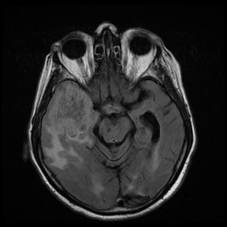 Glioblastoma IDH wild-type | Image | Radiopaedia.org