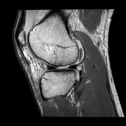 Chondral fracture | Radiology Reference Article | Radiopaedia.org