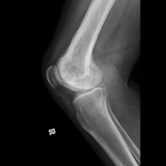 Paget disease bone Radiology Reference Article Radiopaedia