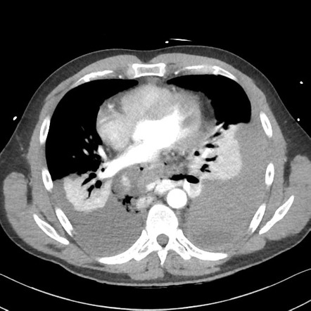 Boerhaave syndrome | Image | Radiopaedia.org