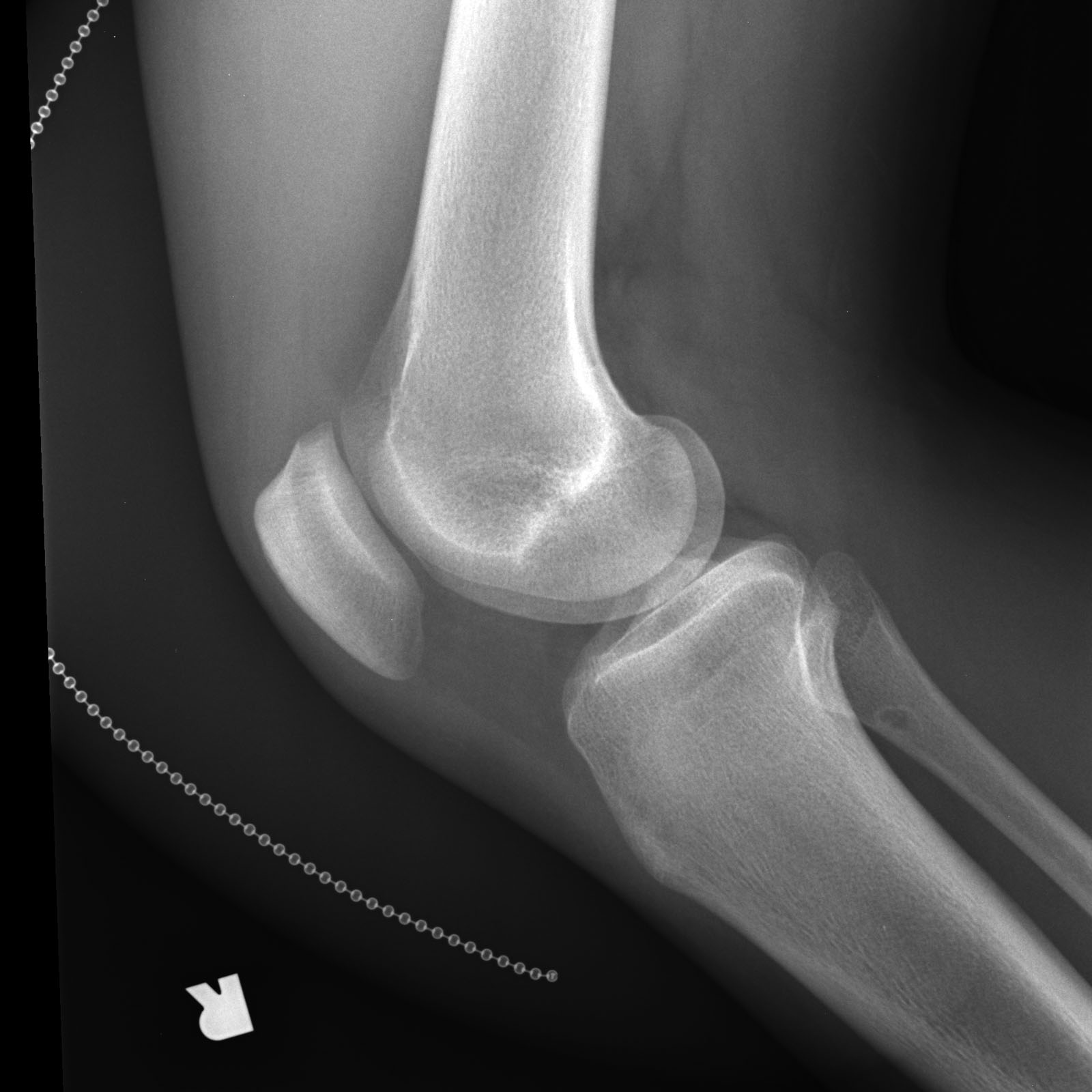 Fibrous cortical defect - proximal fibula | Image | Radiopaedia.org