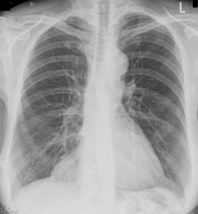 Pericardial cyst | Radiology Case | Radiopaedia.org