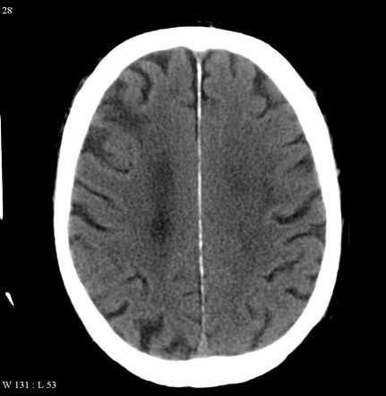 Watershed cerebral infarction | Radiology Reference Article ...