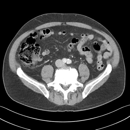 Active diverticular hemorrhage | Image | Radiopaedia.org