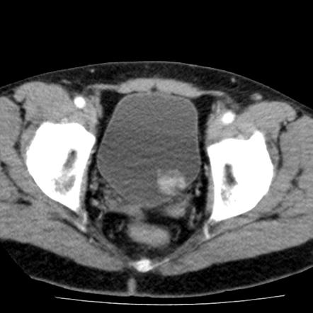 Bladder papillary urothelial carcinoma | Radiology Case | Radiopaedia.org