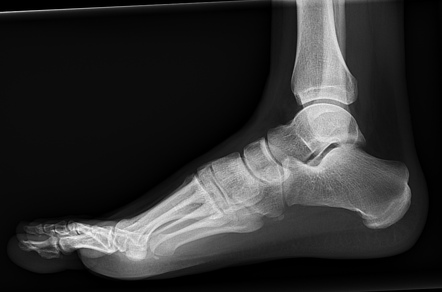 Fracture of calcaneus | Image | Radiopaedia.org