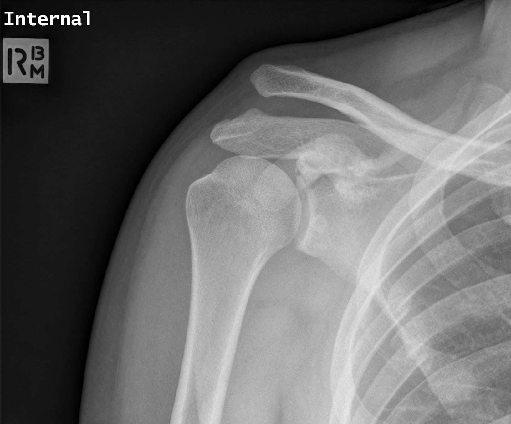 File:Scapular fracture, rib fractures and acromioclavicular joint ...