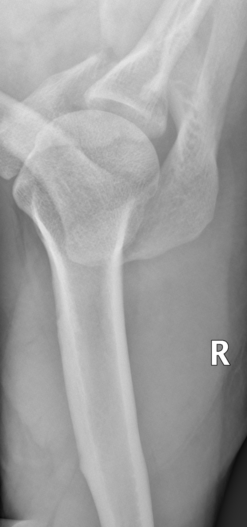 File:Scapular fracture, rib fractures and acromioclavicular joint ...