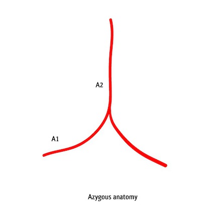 Azygos anterior cerebral artery | Radiology Reference Article ...