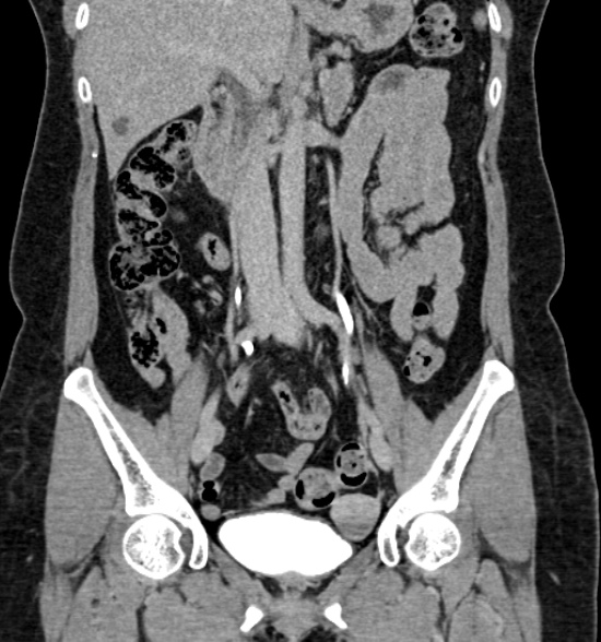 Normal Ct Intravenous Urogram Image