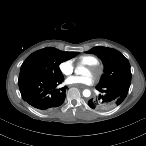 Traumatic Aortic Injury 