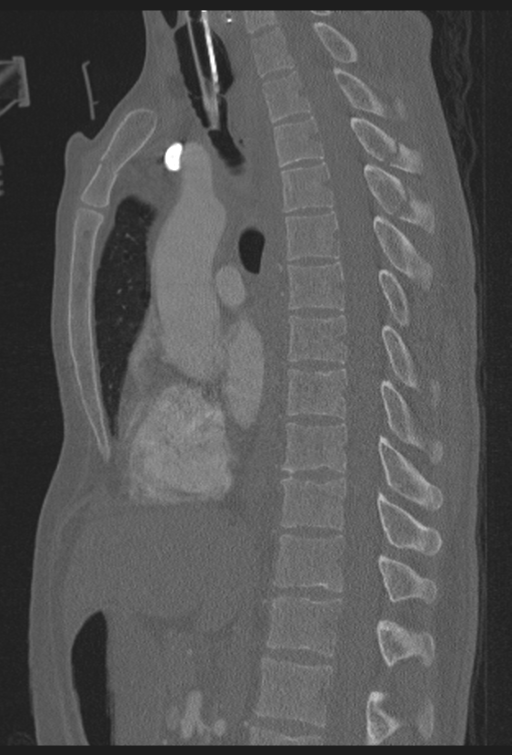 Traumatic Aortic Injury Image