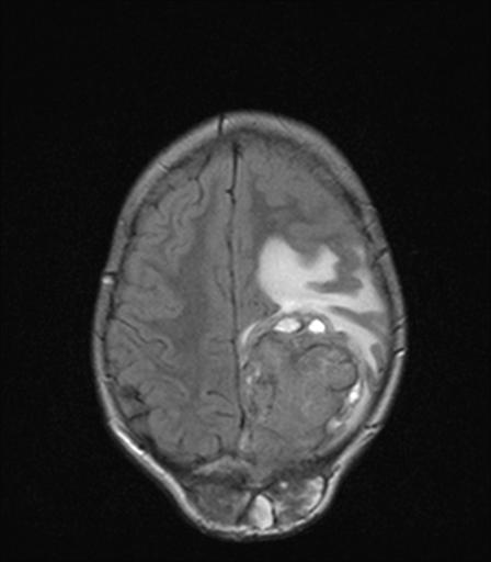 Embryonal tumor with multilayered rosettes (ETMR) | Image | Radiopaedia.org