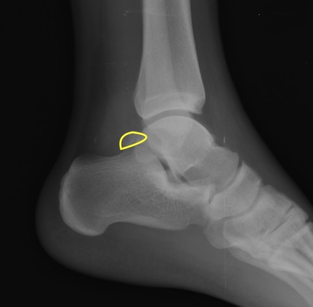 Os trigonum | Radiology Reference Article | Radiopaedia.org