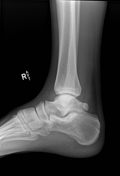 Posterior talar process fracture | Radiology Reference Article ...