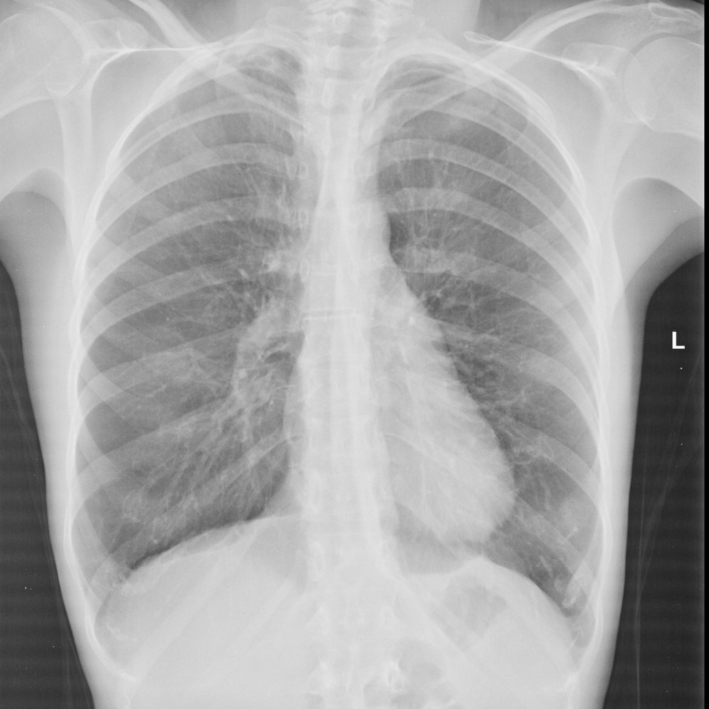 Severe Copd And Pectus Excavatum Radiology Case Radiopaedia Org