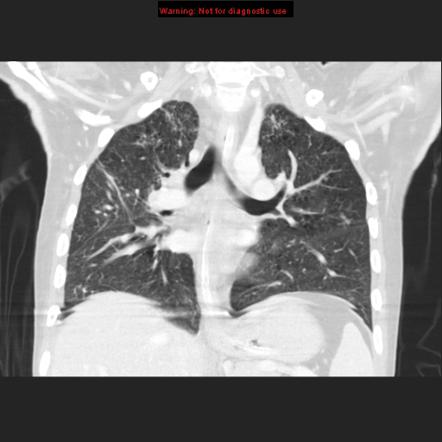 Pulmonary tuberculosis | Image | Radiopaedia.org