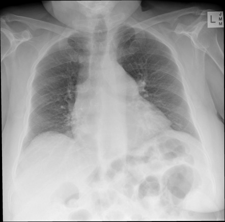 Bilateral coracoclavicular joints | Radiology Case | Radiopaedia.org