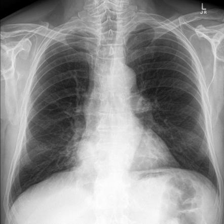 Lung cancer | Radiology Case | Radiopaedia.org