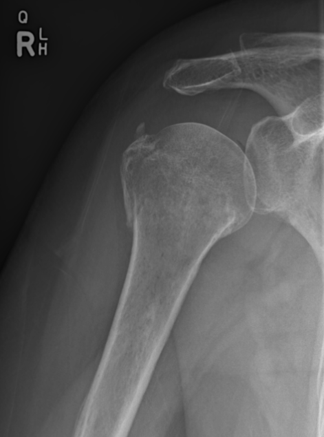 Humerus: standard radiographic series | Image | Radiopaedia.org