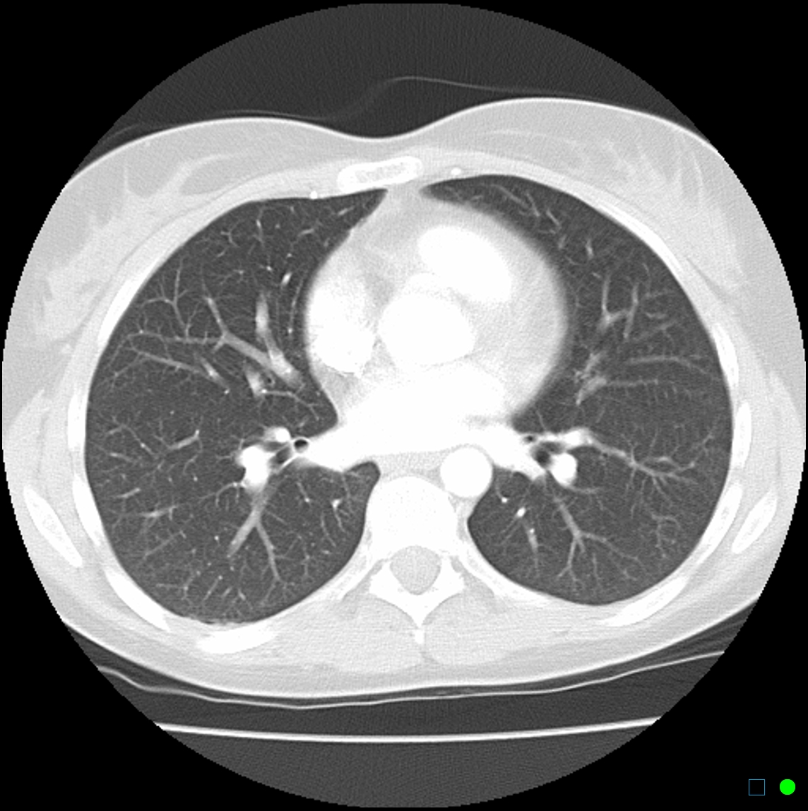 chest-ct-scan-images-dataset-kaggle-vrogue-co