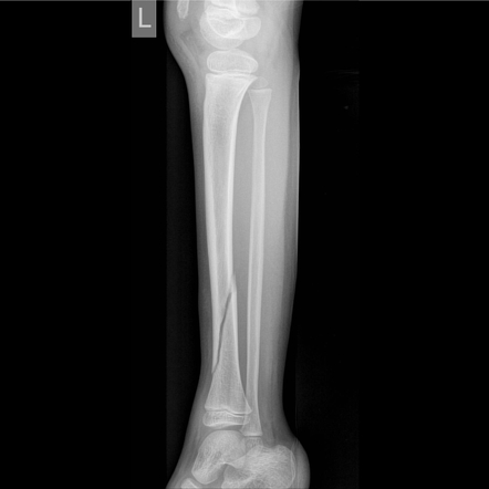 Lower limb radiography | Radiology Reference Article | Radiopaedia.org