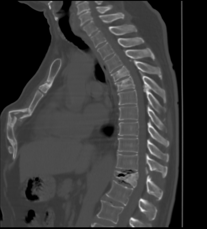 Перелом грудных позвоночников. Компрессионный перелом позвоночника грудного отдела. Компрессионный перелом s 22. Компрессионный перелом 8 позвонка грудного отдела. Дисцит переломом грудного отдела.
