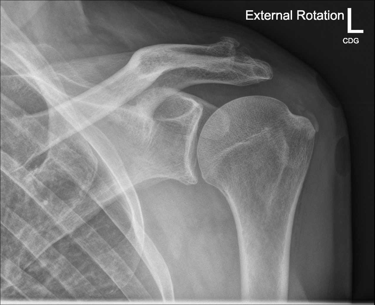 Ultrasound Guided Barbotage Procedure For Calcific